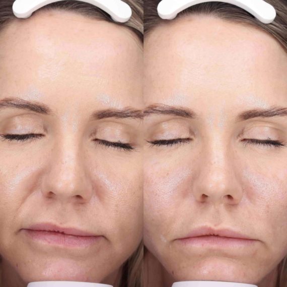 Non Surgical Facelift-min before after woman