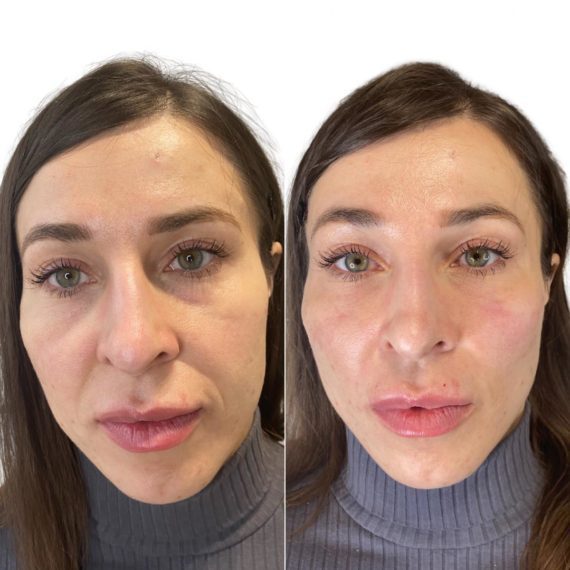 cheek volumisation filler before after sas aesthetics