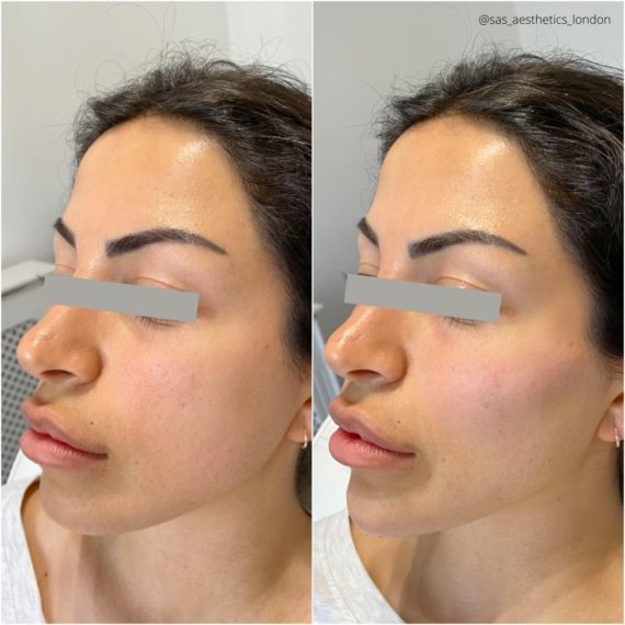 cheek volumisation filler before after sas aesthetics side profile